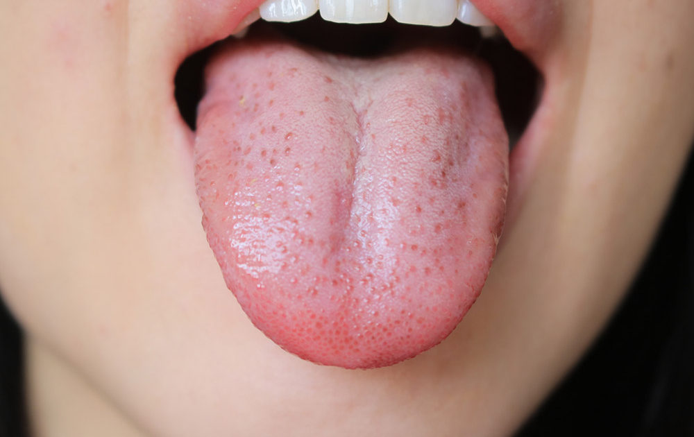 フレイル予防に「舌圧トレーニング」　フレイルのサインは「口の中」に表れる？